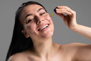Skincare para pele acneica: guia completo para montar uma rotina eficaz