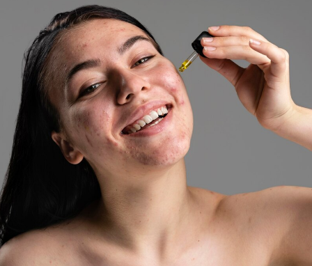 Skincare para pele acneica: guia completo para montar uma rotina eficaz