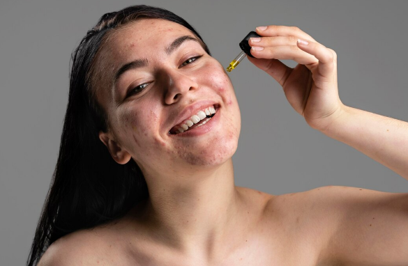 Skincare para pele acneica: guia completo para montar uma rotina eficaz