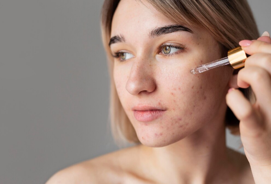 Skincare para pele acneica: guia completo para montar uma rotina eficaz